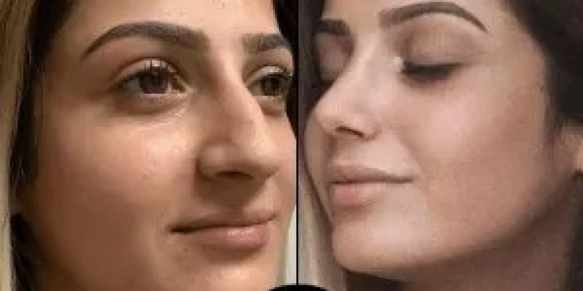 PRP Treatment in Dubai: The Future of Non-Invasive Beauty