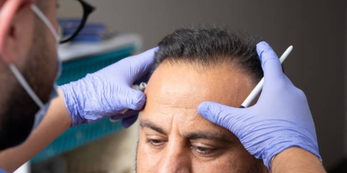 Choosing Right Hair Transplant Method Guide