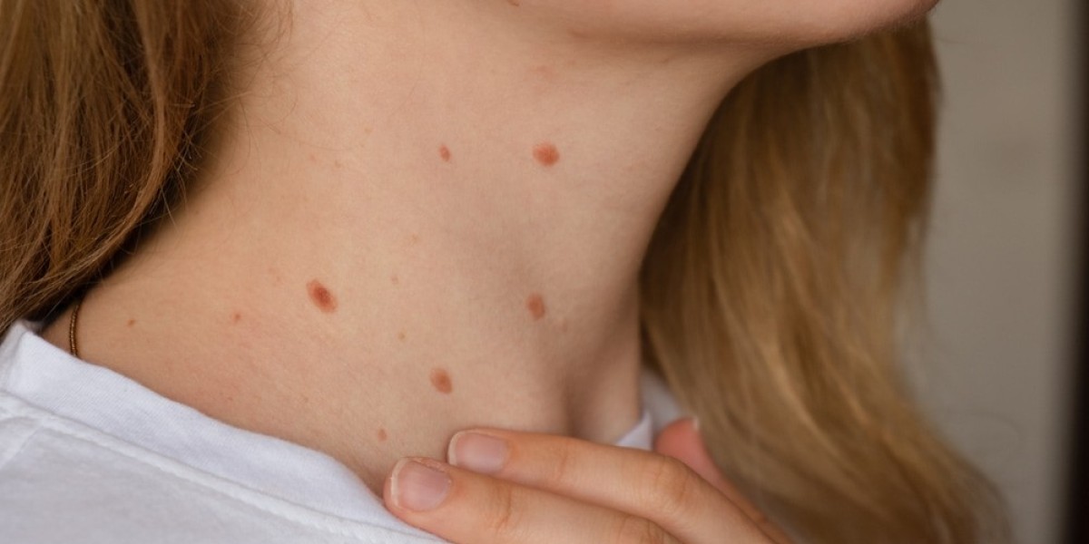 Are Skin Tags Contagious? Prevention and Care Guide