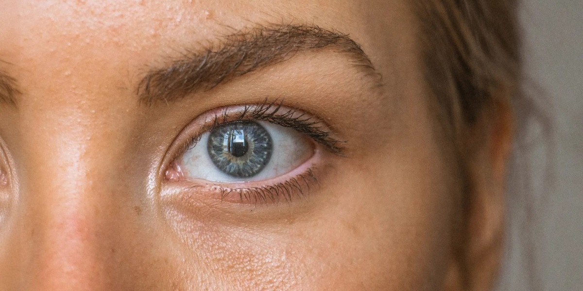 Say Goodbye to Under-Eye Shadows: Expert Dark Circles Remedies