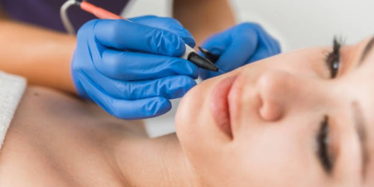 Laser Hair Removal in Riyadh: Pain Level and What to Expect