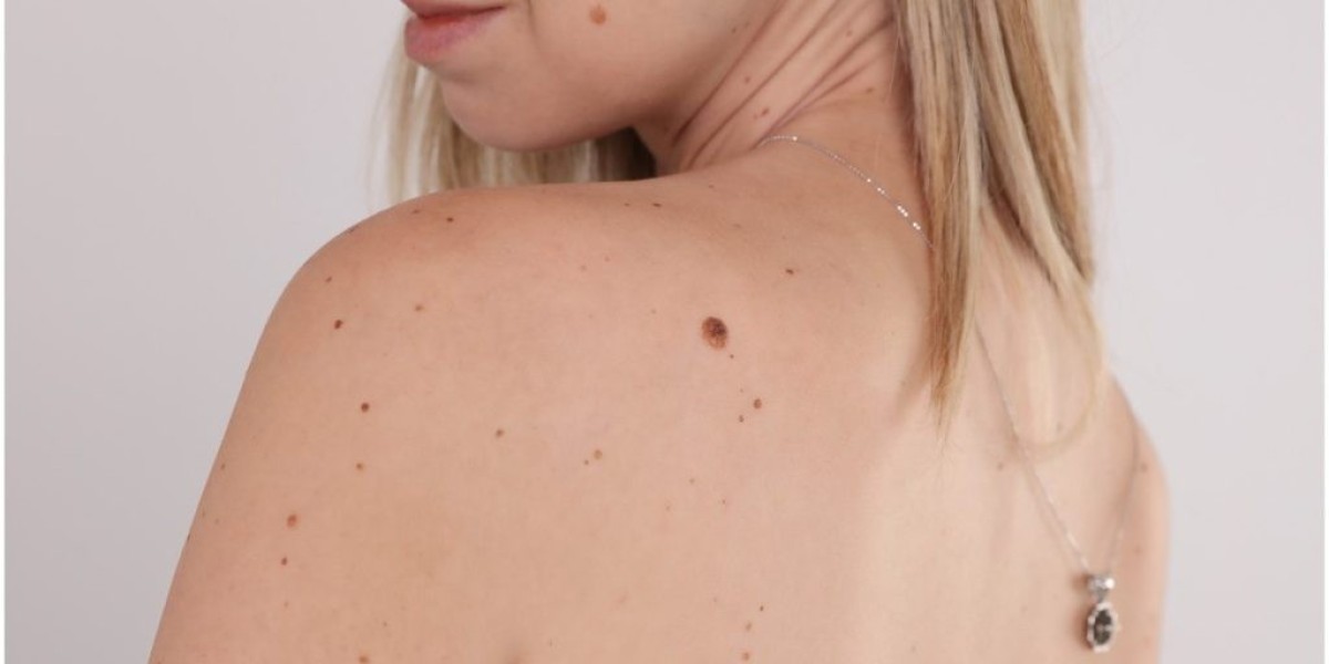 Skin Tag Removal Price | Complete Guide to Costs, Methods & What to Expect