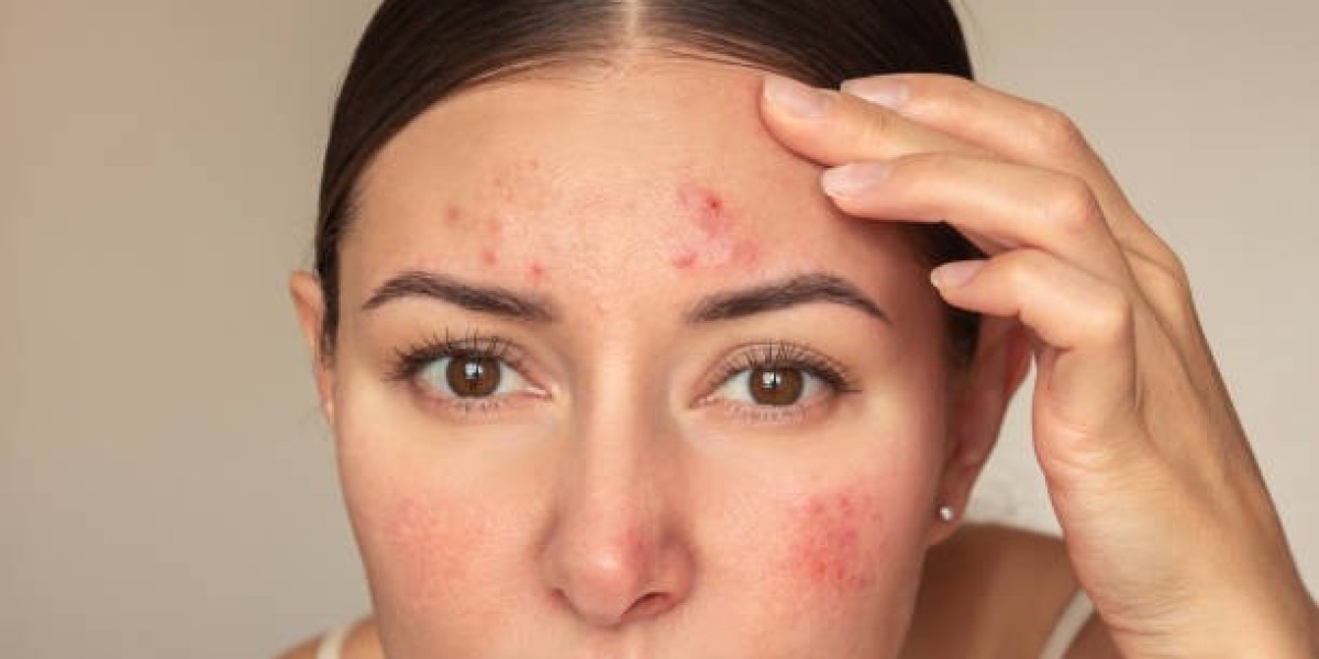 Laser Acne Treatment: Smooth Skin Revolution