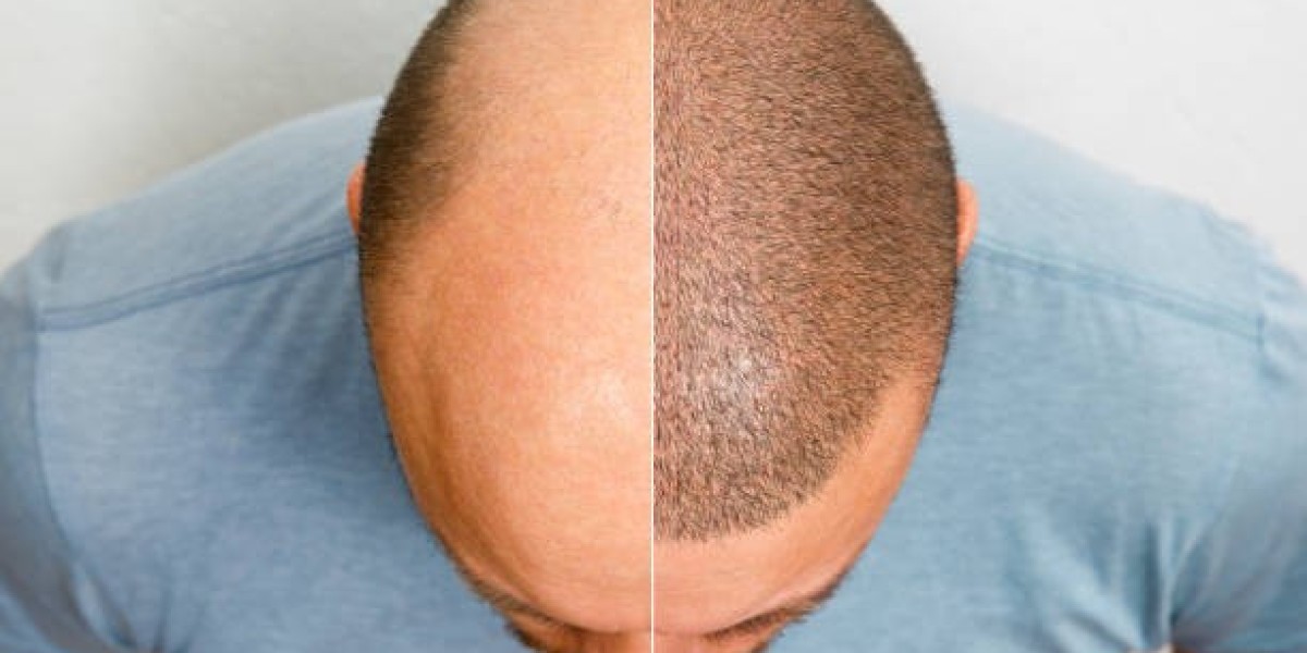Hair Transplantation for Thinning Hair: Effective Restoration Guide