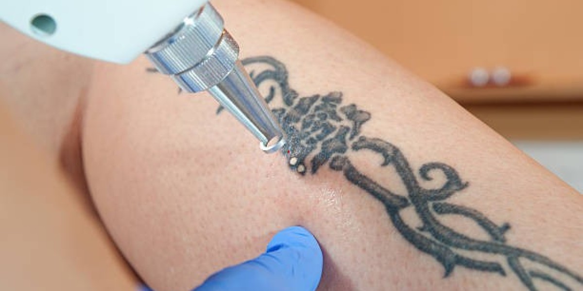 Laser Tattoo Removal Technology and How It Works Safely