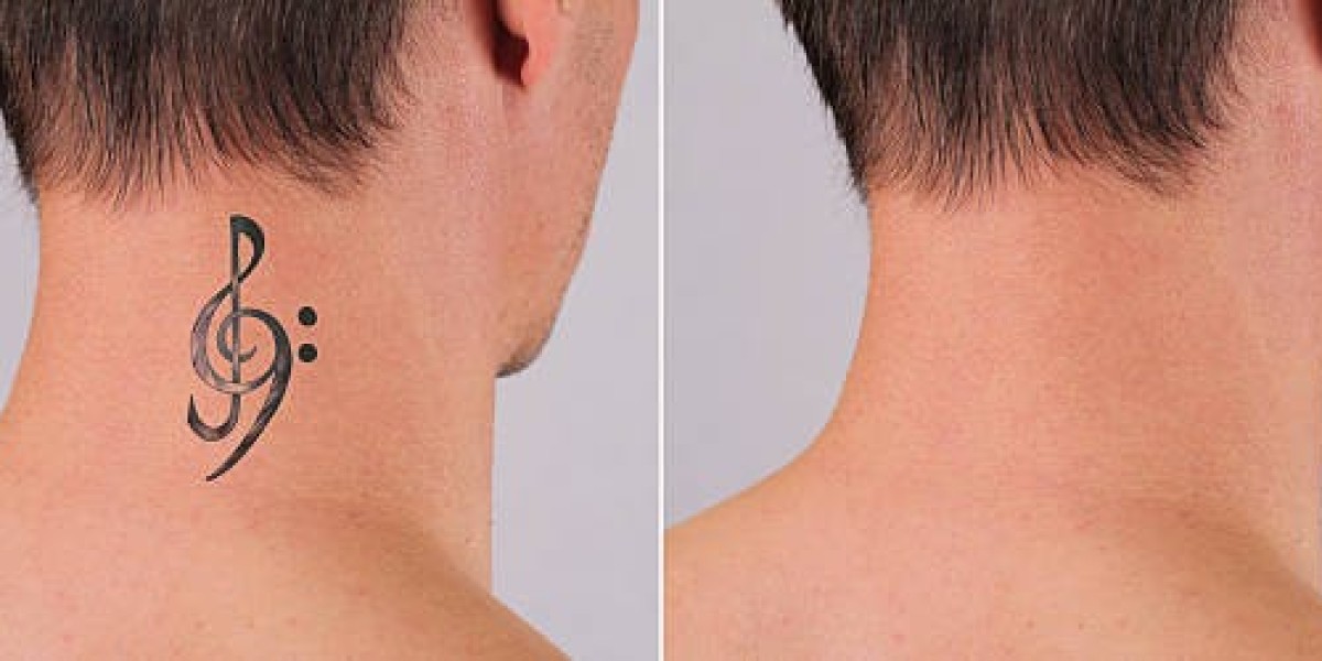Laser Tattoo Removal for Clean and Even Skin Tone