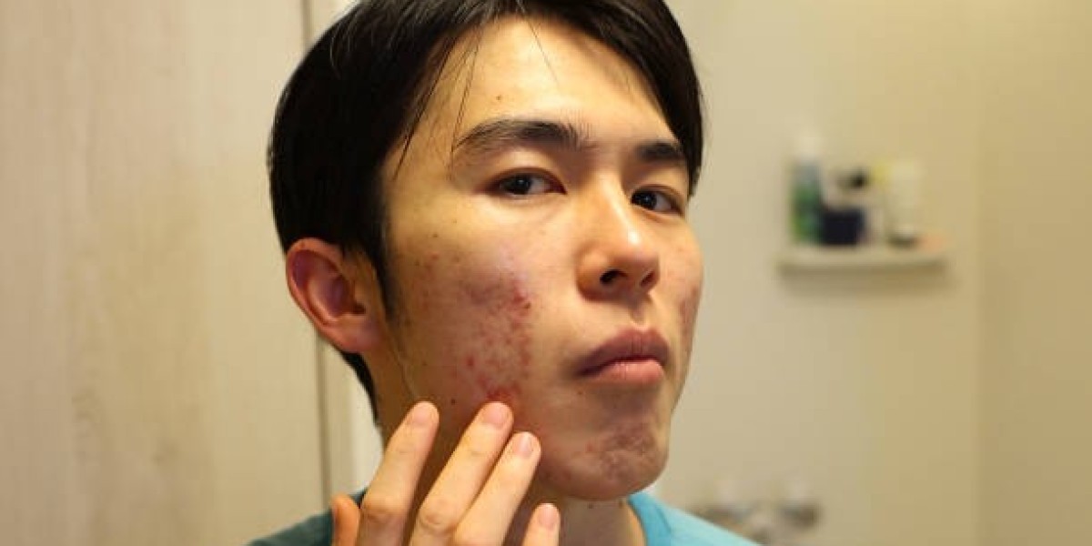 Pimples Treatment Practices for Calmer and Clearer Skin