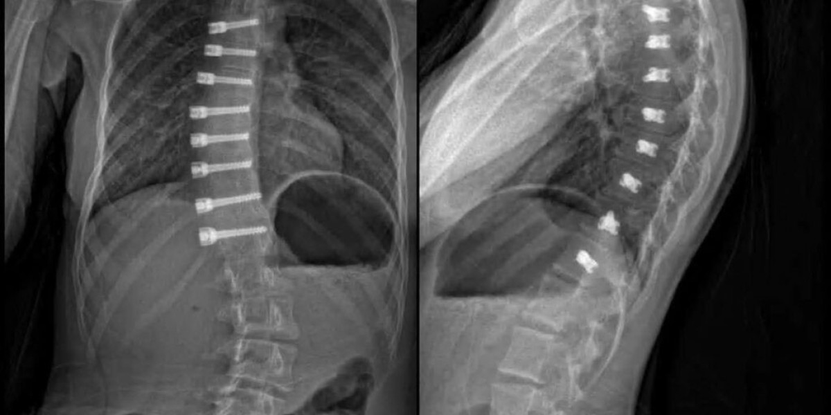 Scoliosis Tethering Surgery