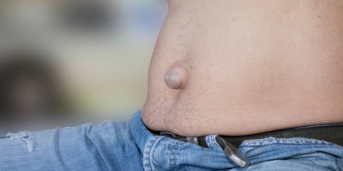 Hernia Surgery Process Explained for Patient Awareness