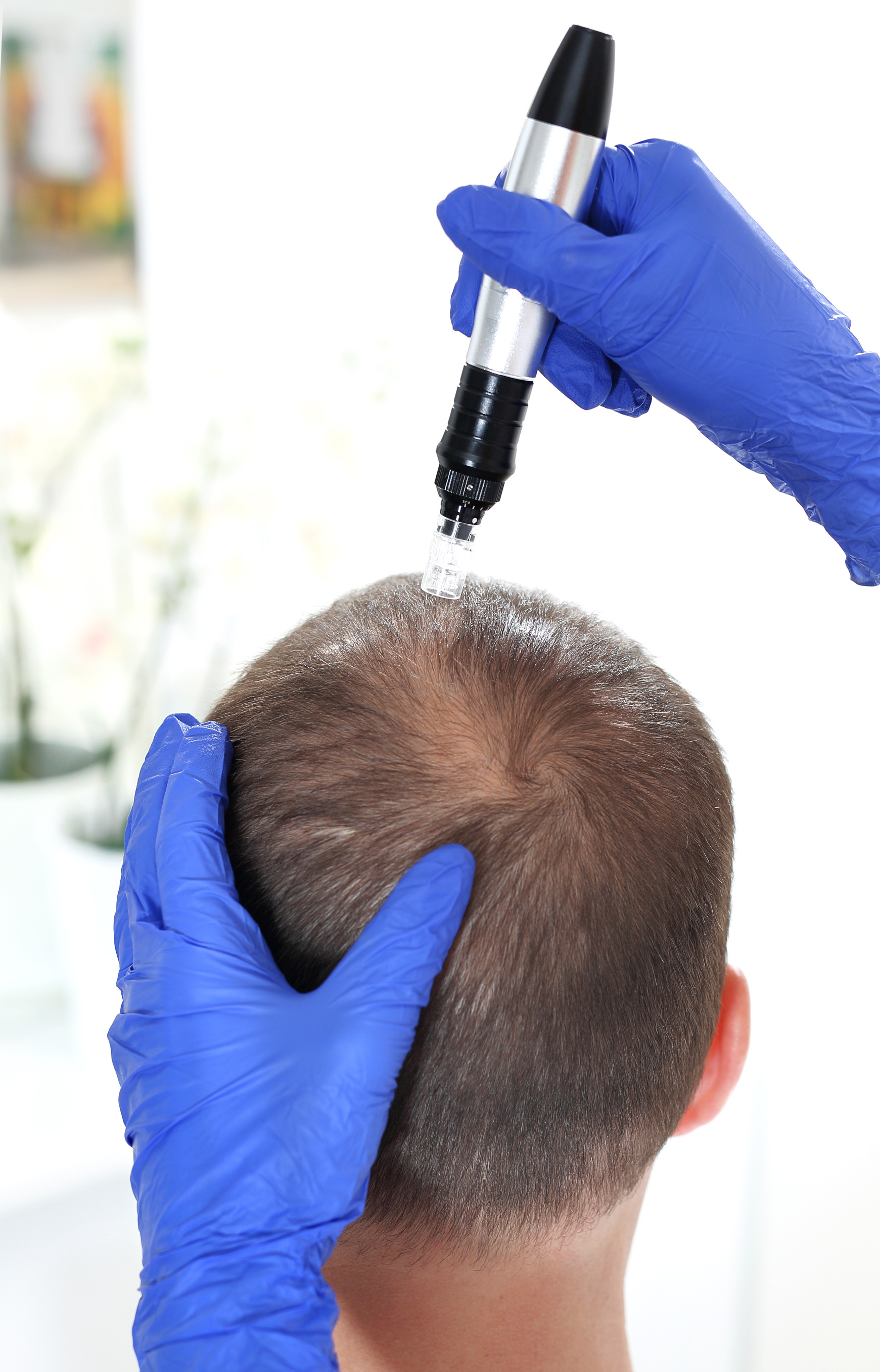 Scalp Microneedling Derby | Microneedling for Hair Growth