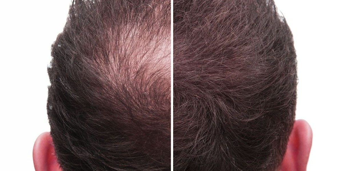 Exosomes vs PRP: Which Treatment Delivers Better Hair Growth?
