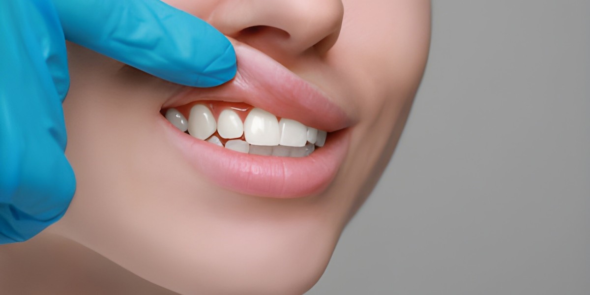 Gum Recontouring Treatment: Redefining Smile Balance with Precision