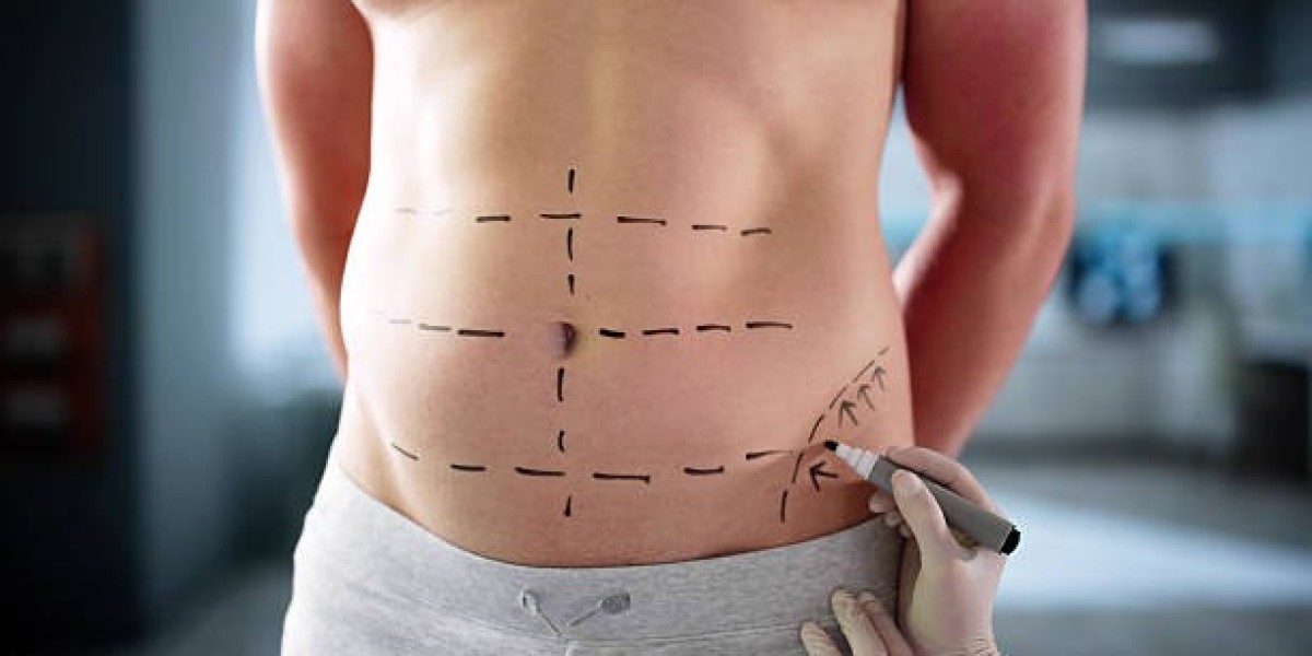 Does Liposuction Procedure Prevent Future Fat?