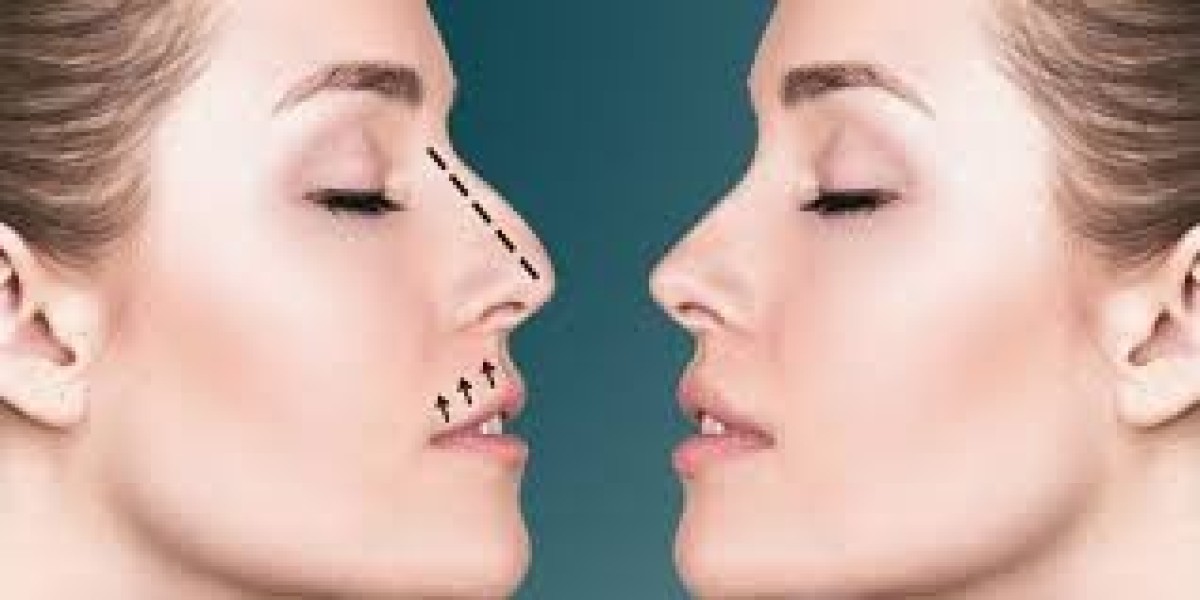 Prepare Perfectly for Rhinoplasty in Riyadh Surgery