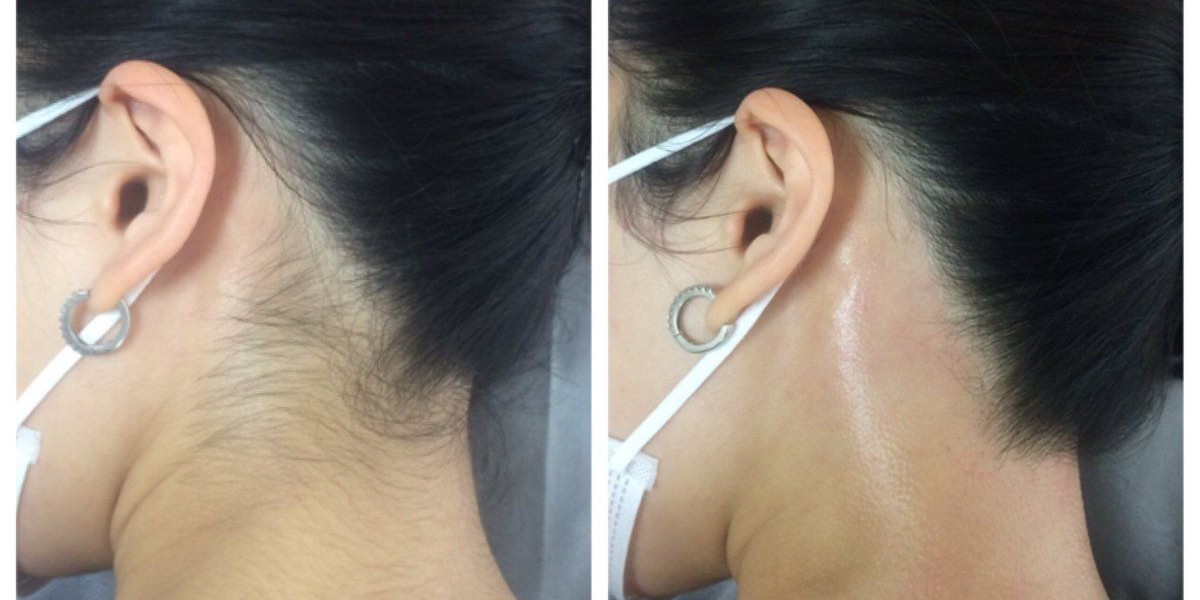 Laser Hair Removal for a Clean and Confident Look