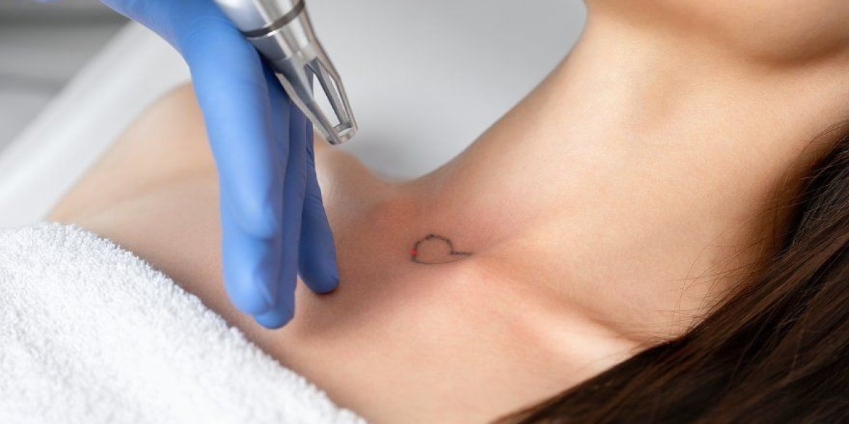 Advanced Laser Tattoo Removal by Experts at Royal Clinic