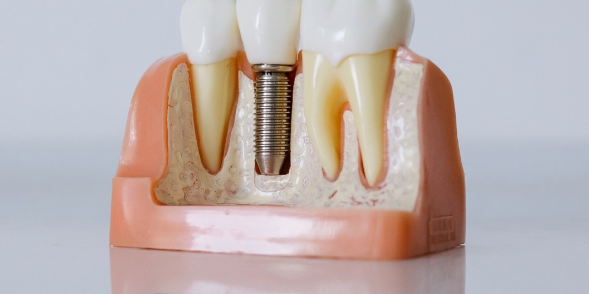 Detailed Overview of Dental Implant Cost in Dubai