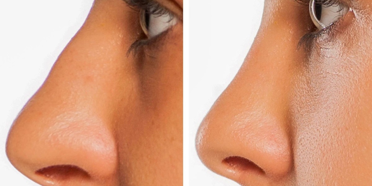 Female Rhinoplasty Guide: Creating Natural and Balanced Results