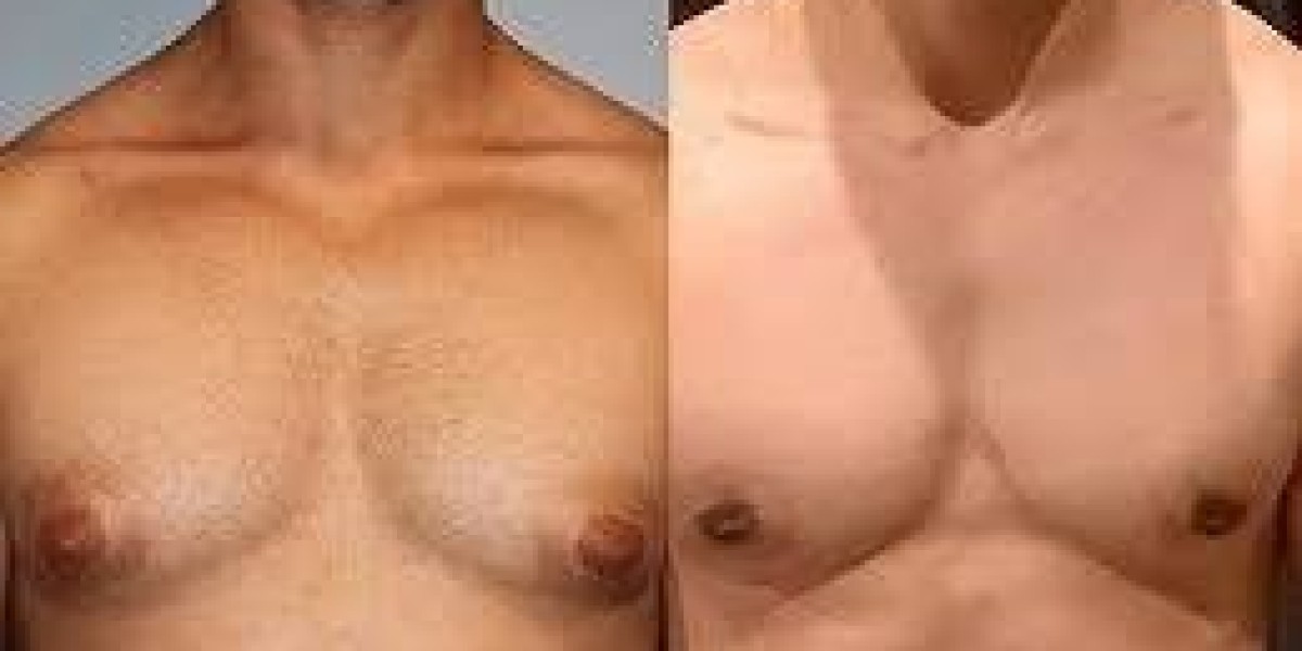 Experienced Surgeons for Gynecomastia Correction in Dubai