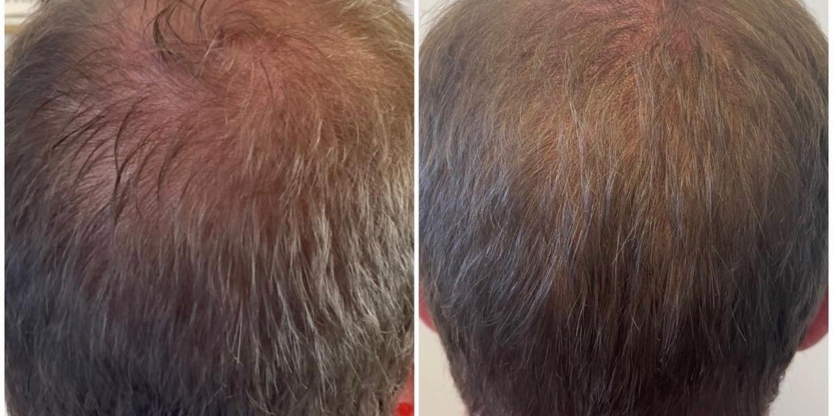 Hair Transplant in Dubai: A Comprehensive Guide to Follicular Science