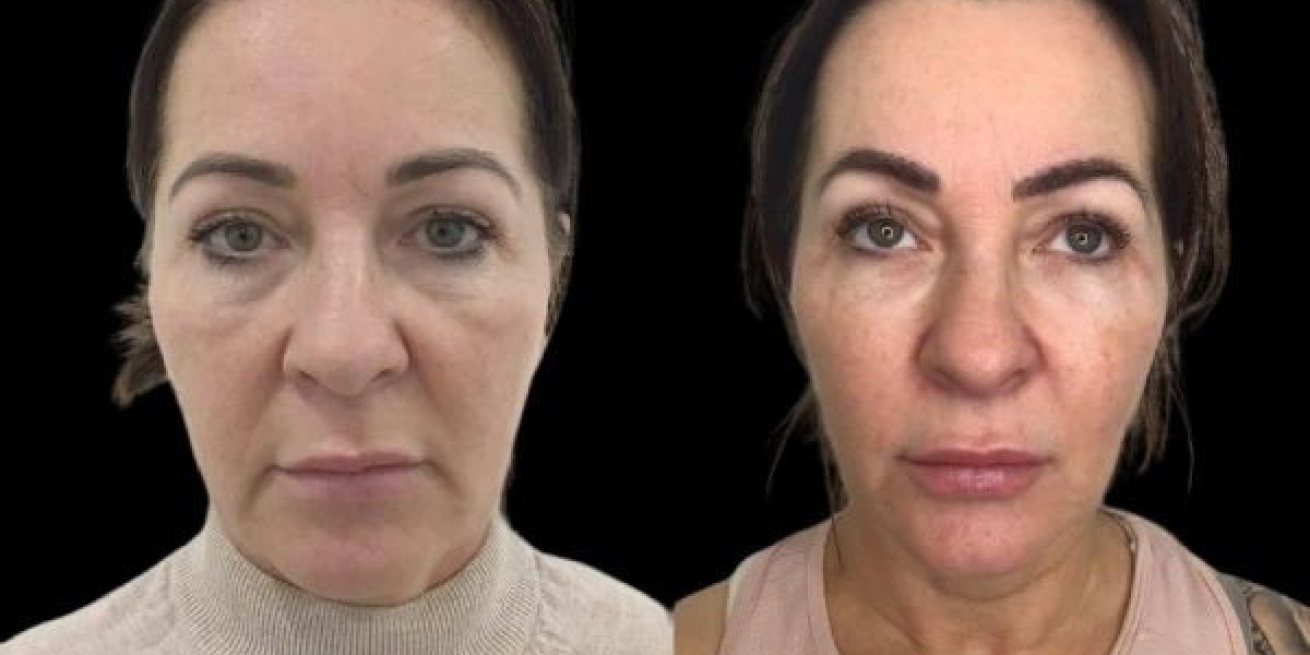 How Does the Best Plastic Surgeon in Dubai Use Profhilo?