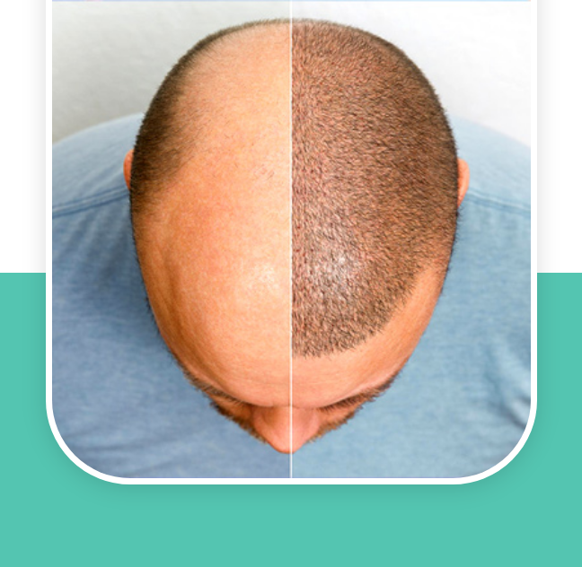 Best Hair Transplant Clinic in Noida | Apolo Hair Clinic
