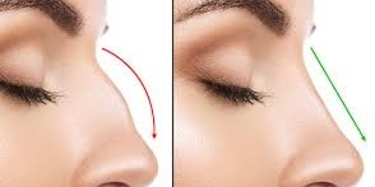 Innovative Rhinoplasty Procedures in Dubai – Transform Your Look Safely