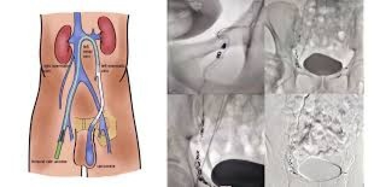 Best Uterine Fibroids Treatment: Safe & Effective Options