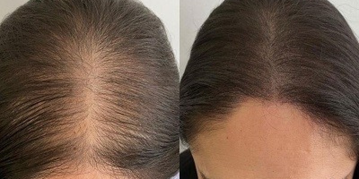 PRP Hair Treatment in Dubai for Natural Hair Restoration