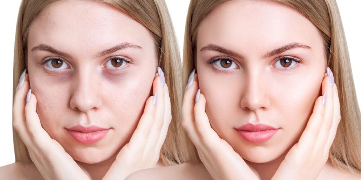 How Does Under Eye Filler Smooth Wrinkles And Restore Eye Contours