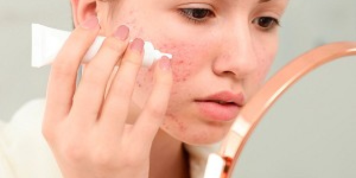 Pimples Treatment in Dubai: Clinical Solutions That Work