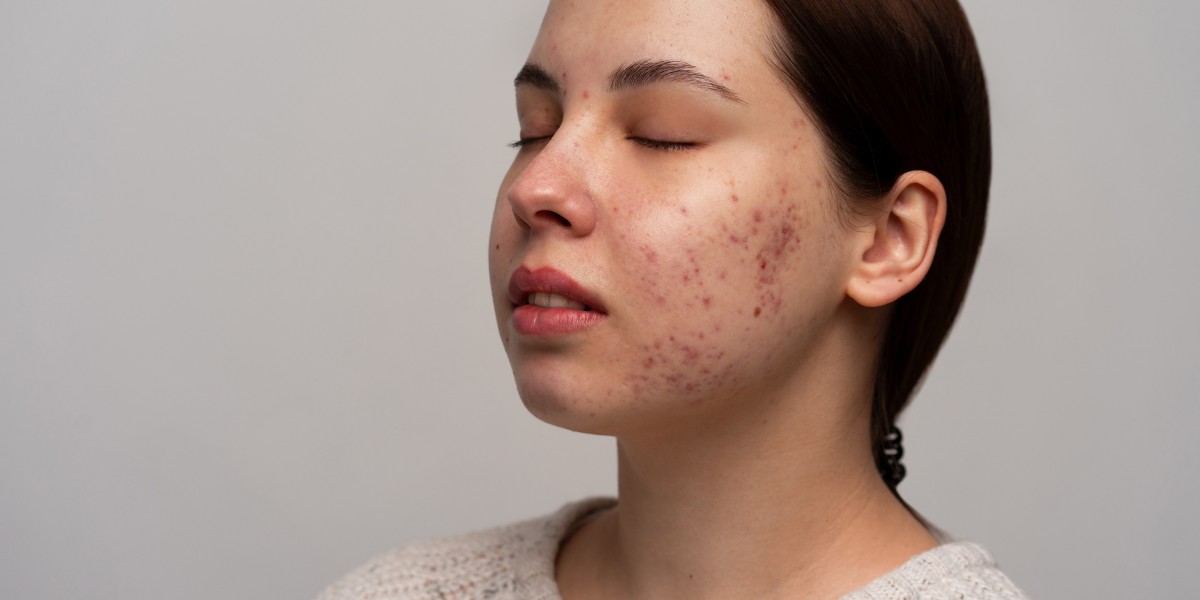 Can Acne Scars Be Fully Removed? Expert Opinion