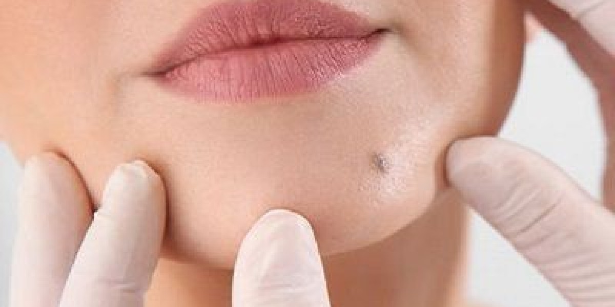 Mole Removal in Dubai: Advanced Clinical Standards for Skin Clarity