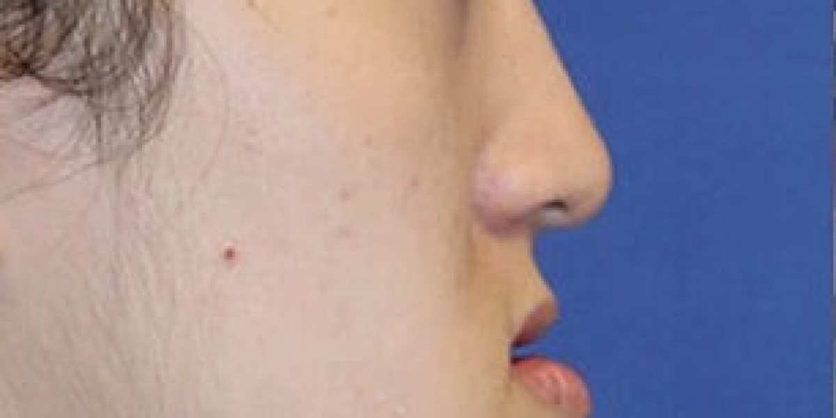 Jaw Surgery in Islamabad: Expert Recommendations