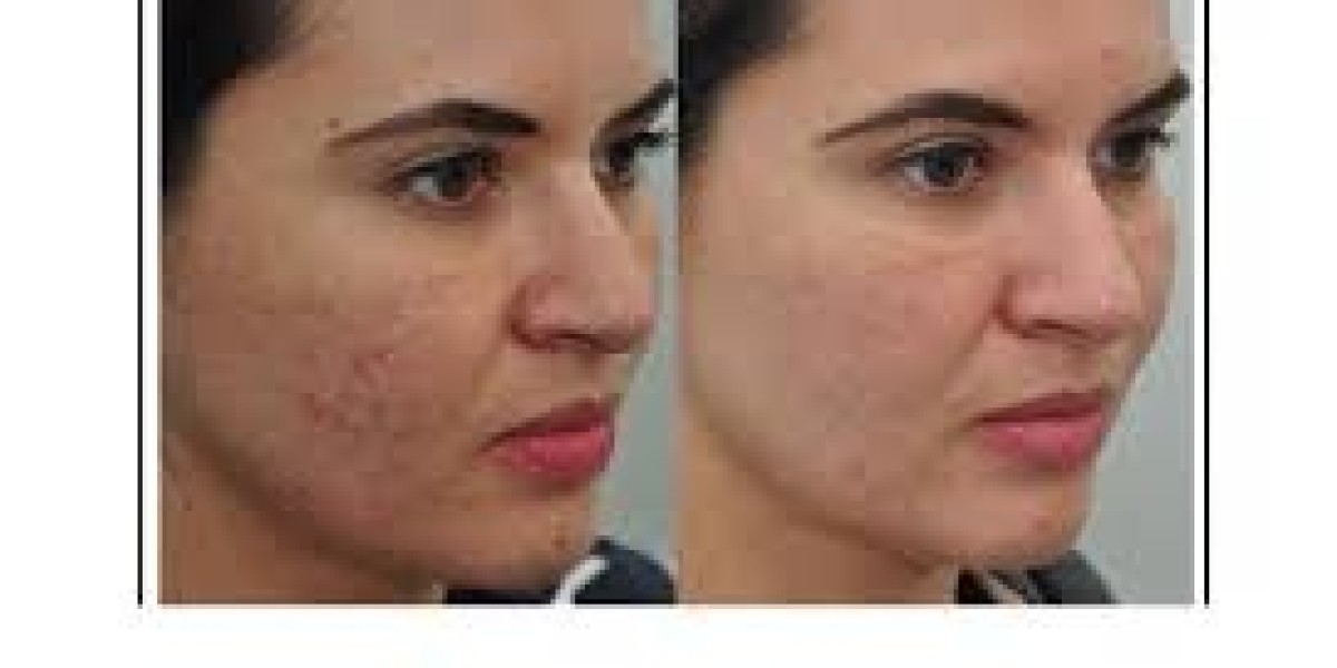 Laser Skin Resurfacing Specialists in Dubai – Advanced Skin Rejuvenation Guide