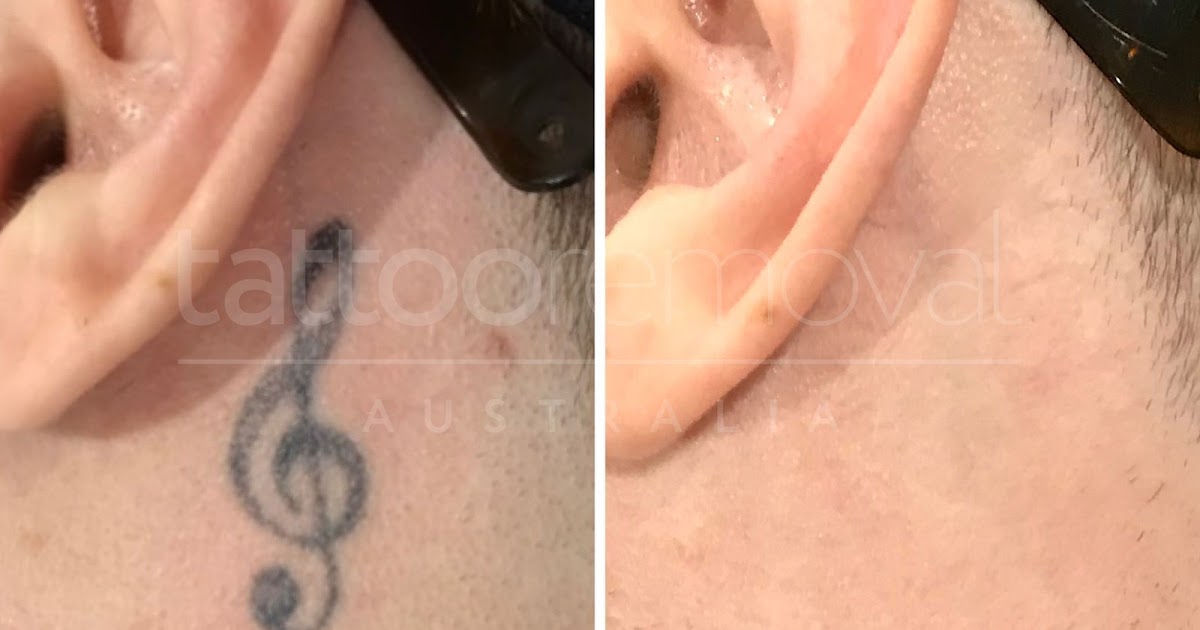 Start a Career in Laser Tattoo Removal: What You Need to Know