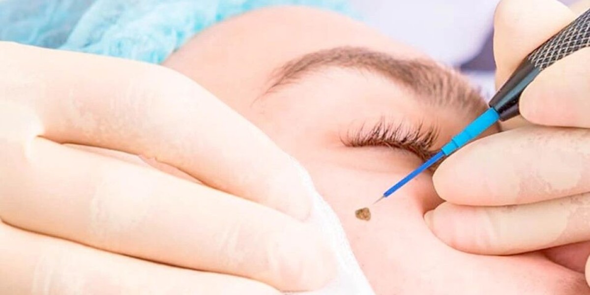 Wart Removal in Islamabad: Say Goodbye to Skin Imperfections