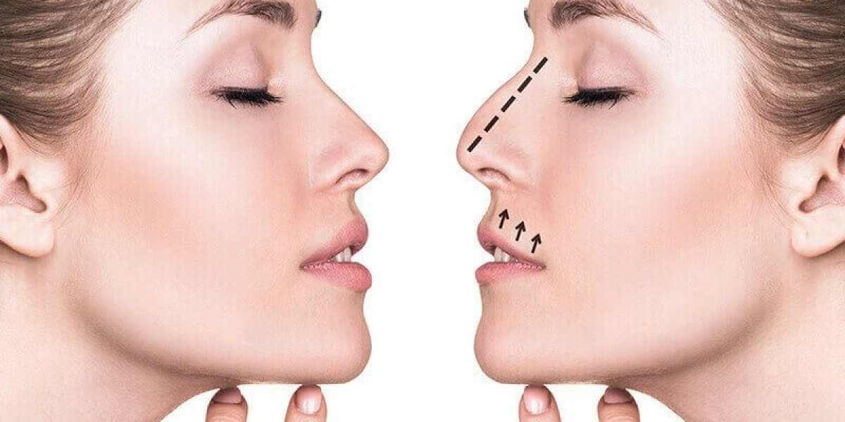 Advanced Nose Enhancement for Refined Structural Goals at Glam Aesthethic Clinic