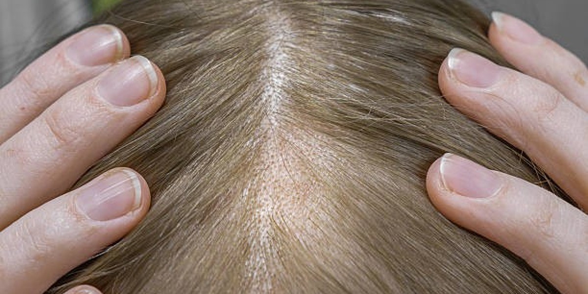 Effective Alopecia Areata Treatment in Andheri by Adore Skin Clinic Hair Restoration