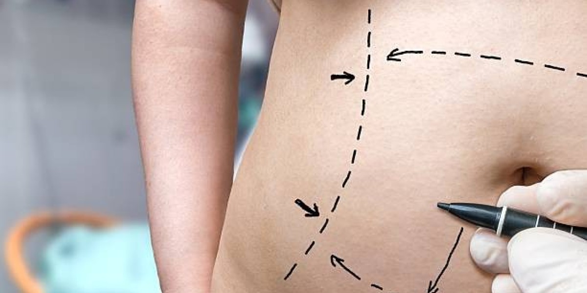 Liposuction in Islamabad vs Dieting: Which Gives Better Results?