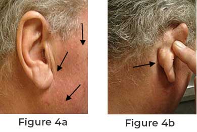 Parotid Tumor | Parotidectomy and Facelift | Parotid Tumor Surgery | Alpha Surgical Group