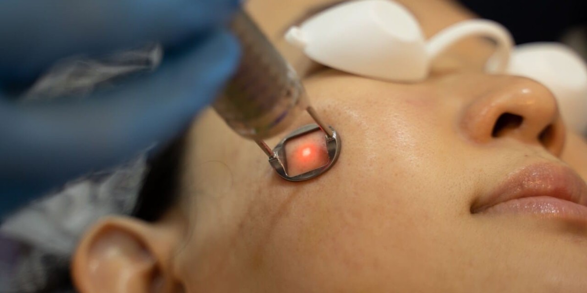 PICO Laser Treatment In Islamabad: Fast Recovery and Amazing Results
