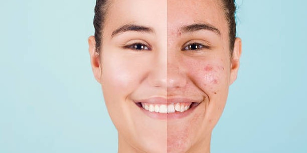 Clear Skin Journey Starts with Acne Treatment In Islamabad
