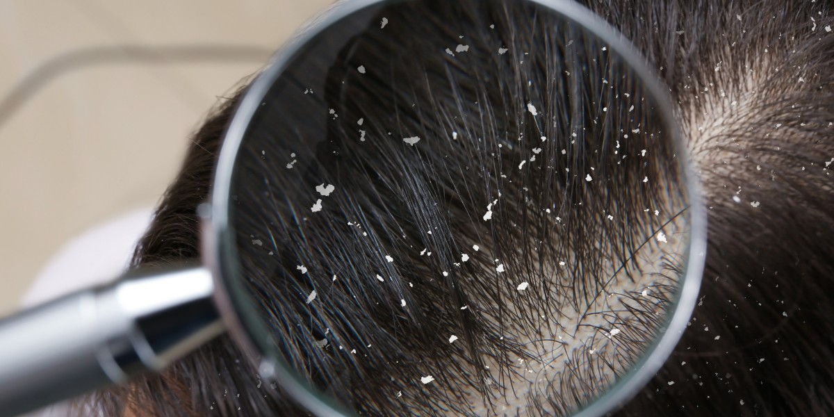 Best Anti-Dandruff Shampoo & Hair Care Guide