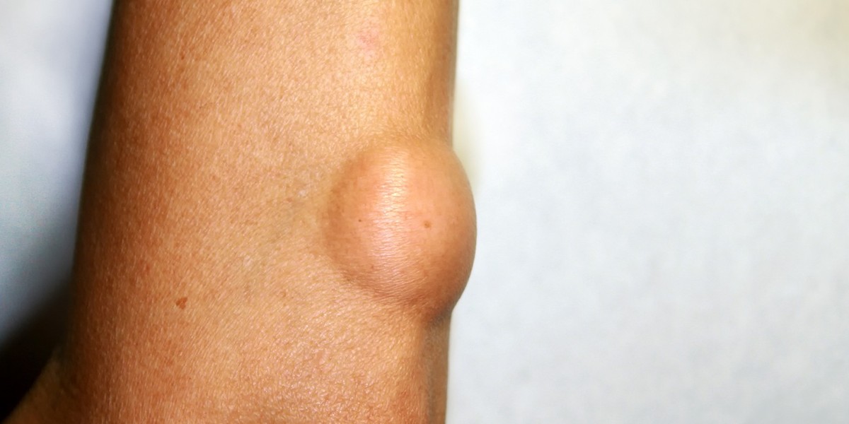 Lipoma Treatment Cost Explained in Simple Terms