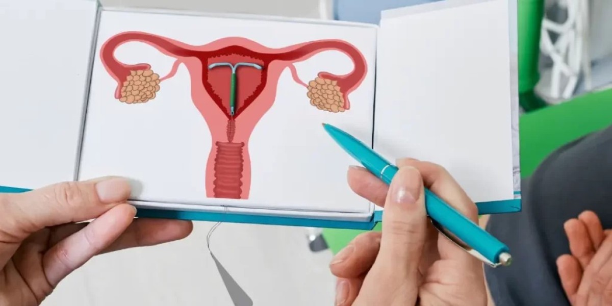 Is IUD Insertion Copper easy method for birth control?