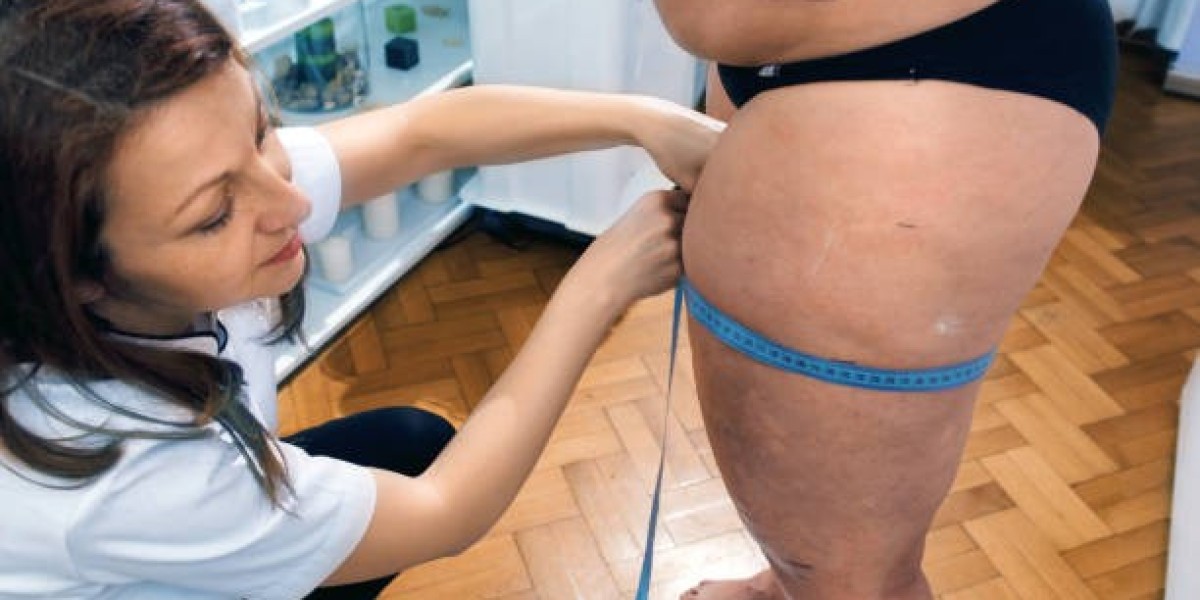 What Is Combined Decongestive Therapy for Lipedema?