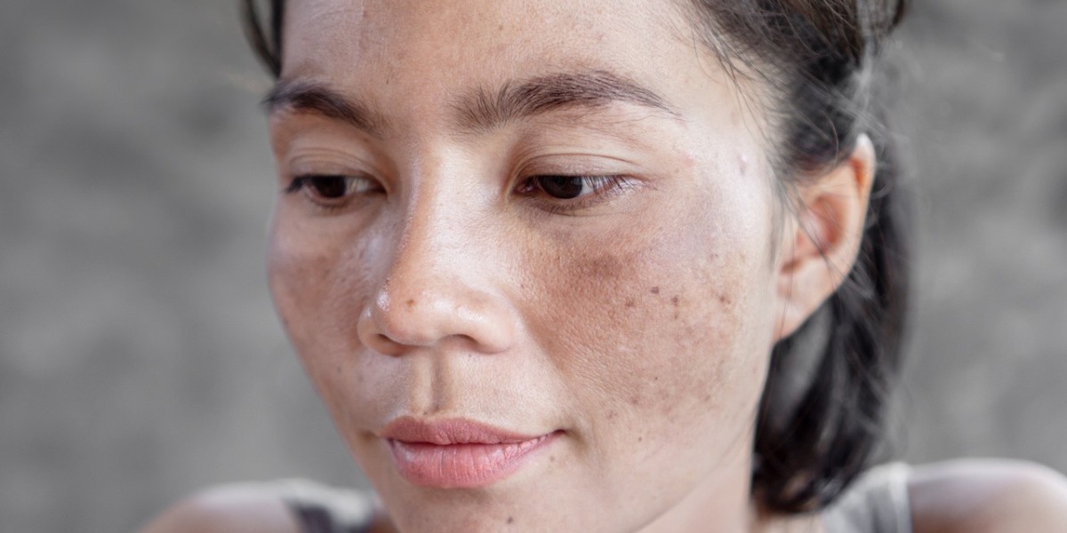 Stress and Skin: Does It Affect Melasma Treatment?