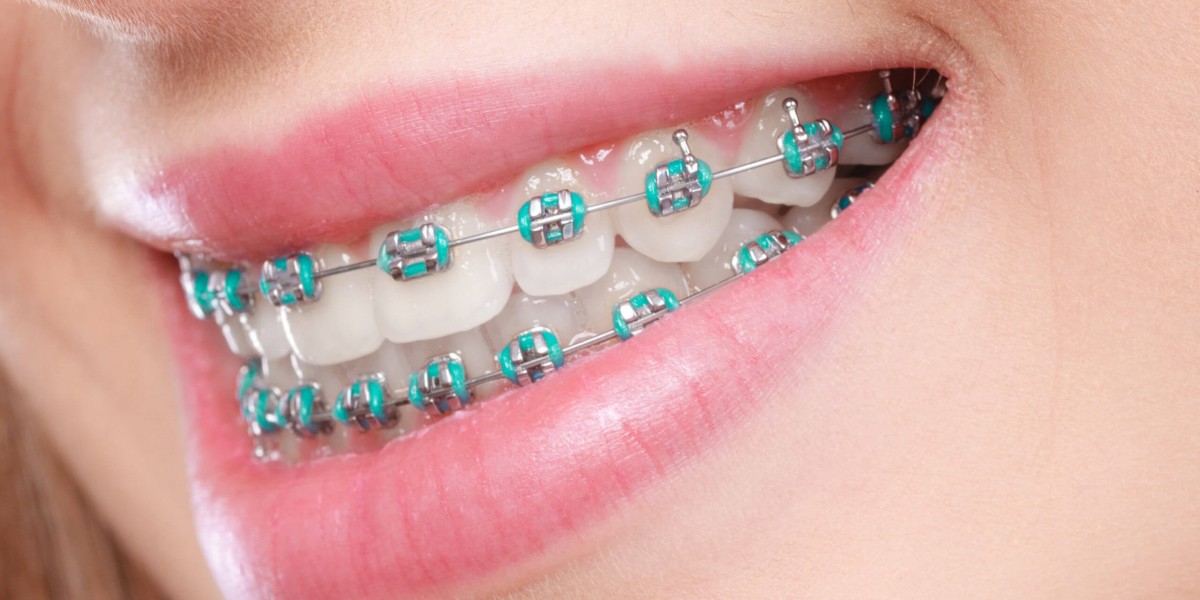 Signs You May Need Dental Braces for a Healthier Smile
