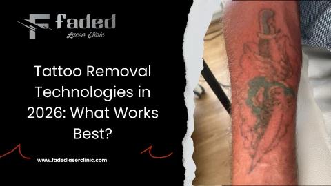 Tattoo Removal Technologies in 2026 What Works Best